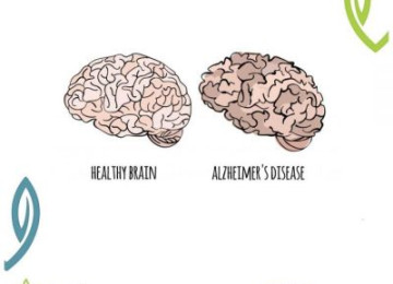 Alzheimer's disease 