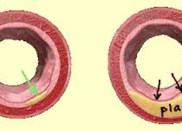 A Simple and Effective Step to Reduce Heart Plaque and Reduce Your Risk of a Heart Attack