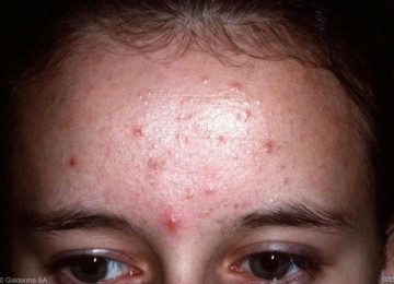 Skin Picking Disorder; Dermatillomania 