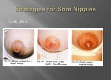Breastfeeding and Sore Nipples